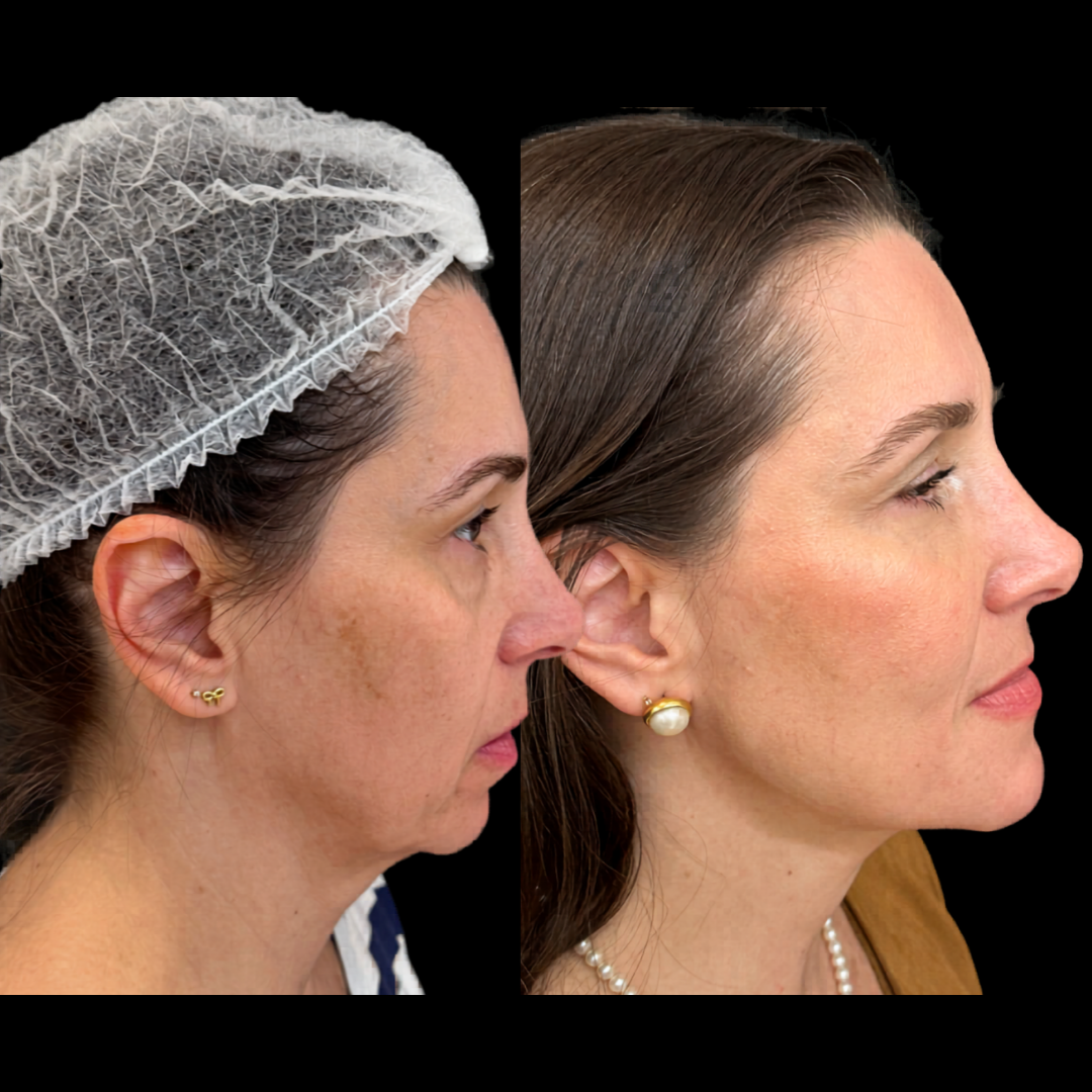 Antes e depois - caso 1