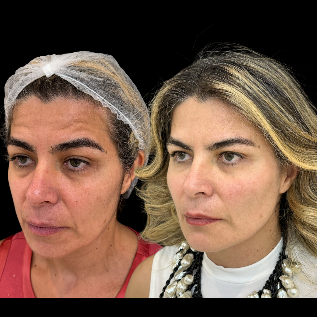 Antes e depois - caso 2