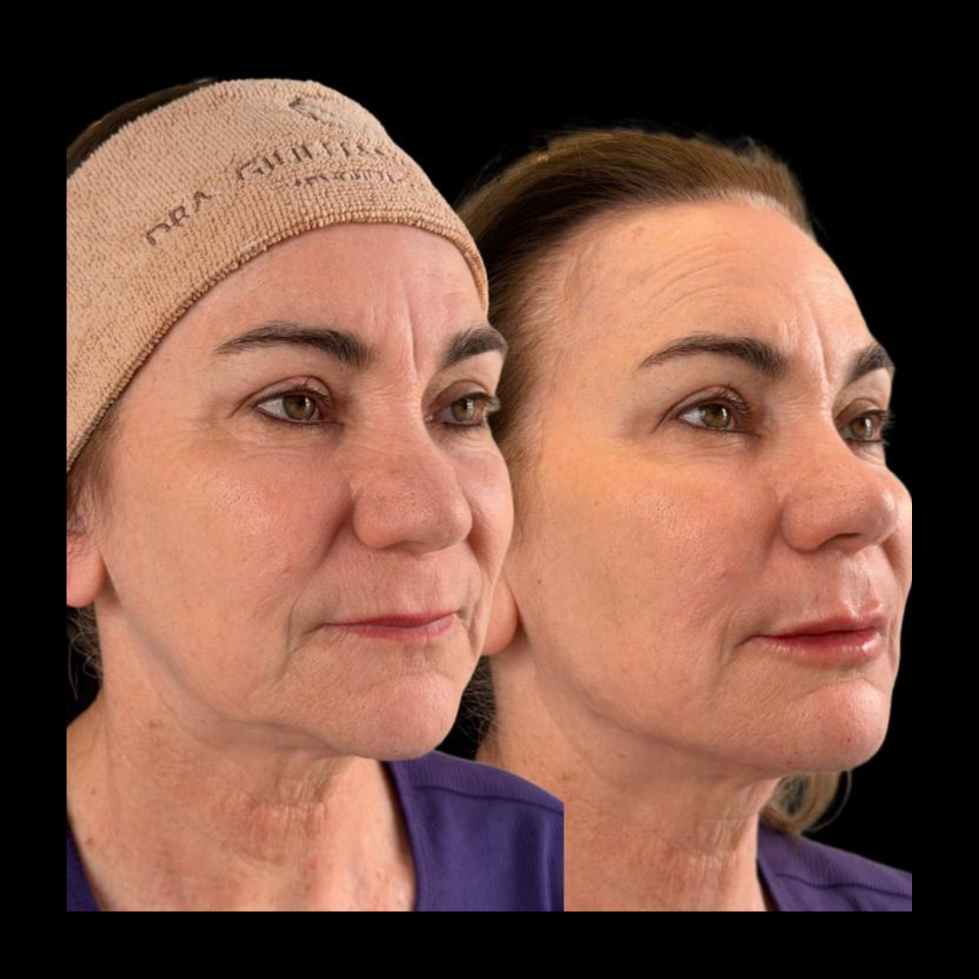 Antes e depois - caso 3