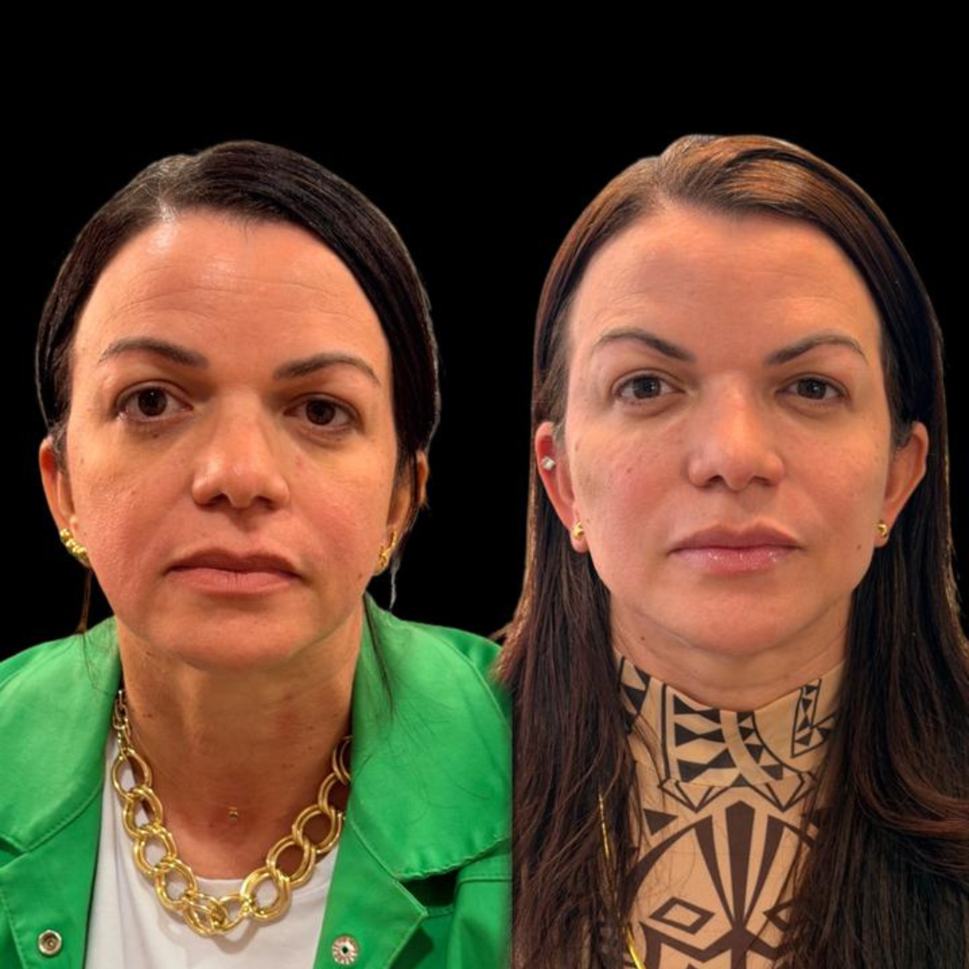 Antes e depois - caso 4